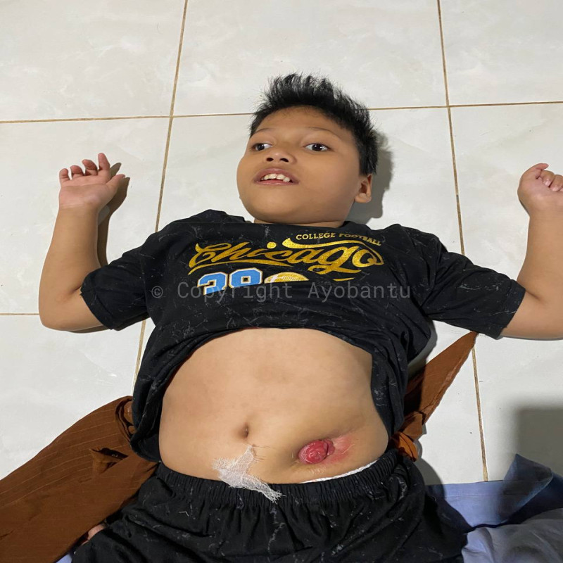 Tiap Hari Bergantung pada Kantong Kolostomi, Rozi Berharap Sembuh dan Sehat!