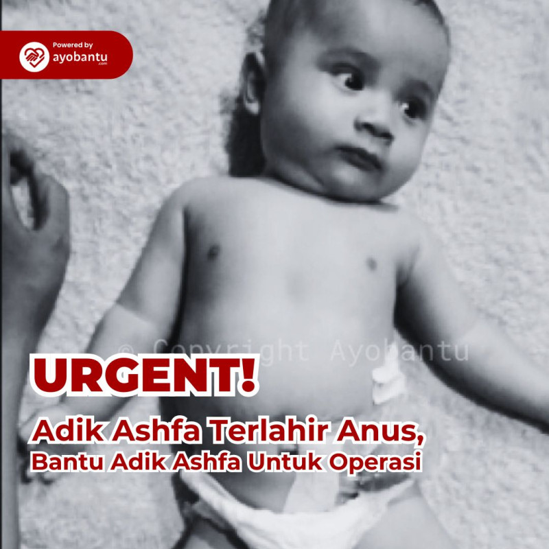 Bantu Bayi Ashfa Lahir Tanpa Anus, harus segera jalani 3 kali Operasi