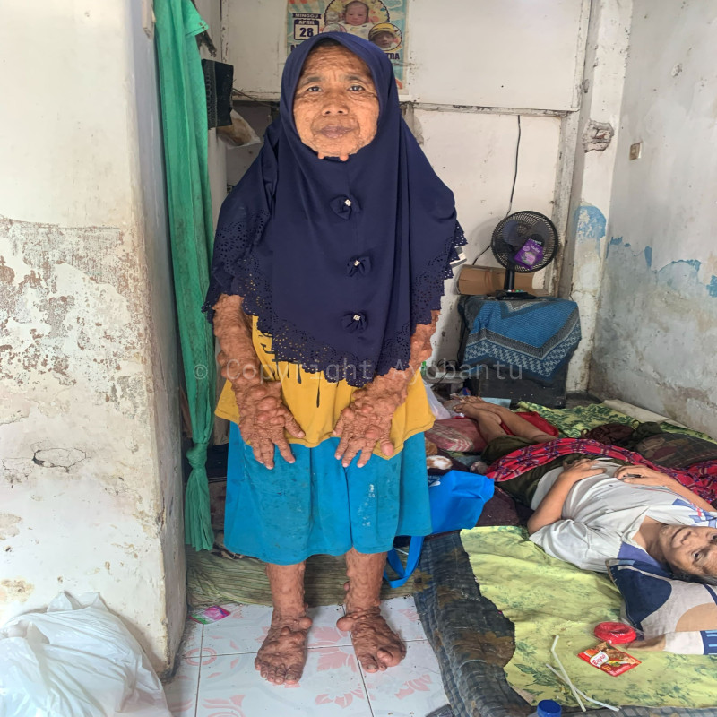 Bantu Kehidupan Ibu Sulastri dan Orang Tua Lumpuh