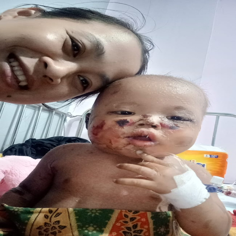 Kulitnya Melepuh Akibat Kemo, Bantu Nara Berjuang Lawan Leukemia