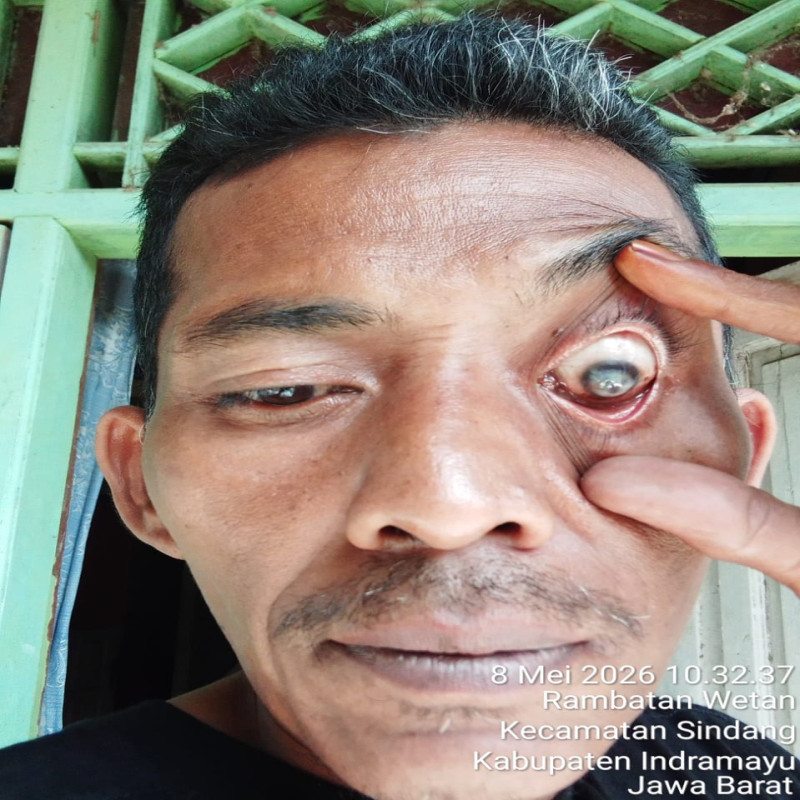 Bantu bapak Warjo melawan penyakit infeksi mata (glaucoma)