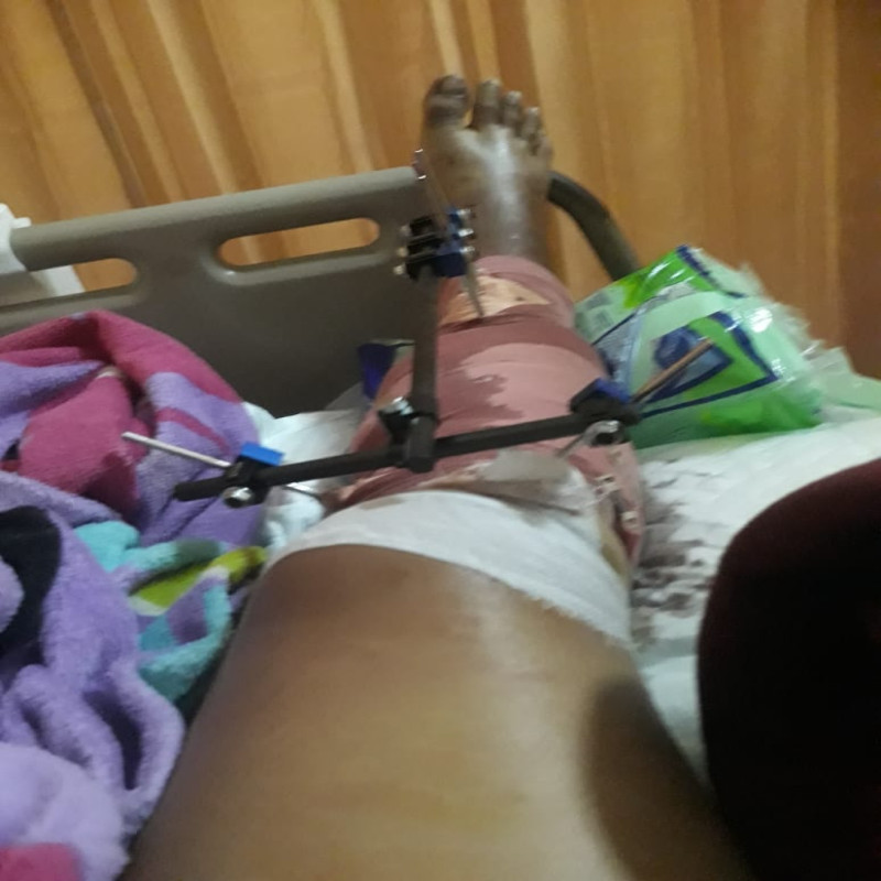 Menjadi korban tabrak lari Driver Gojek berjuang melawan PATAH KAKI kanan.