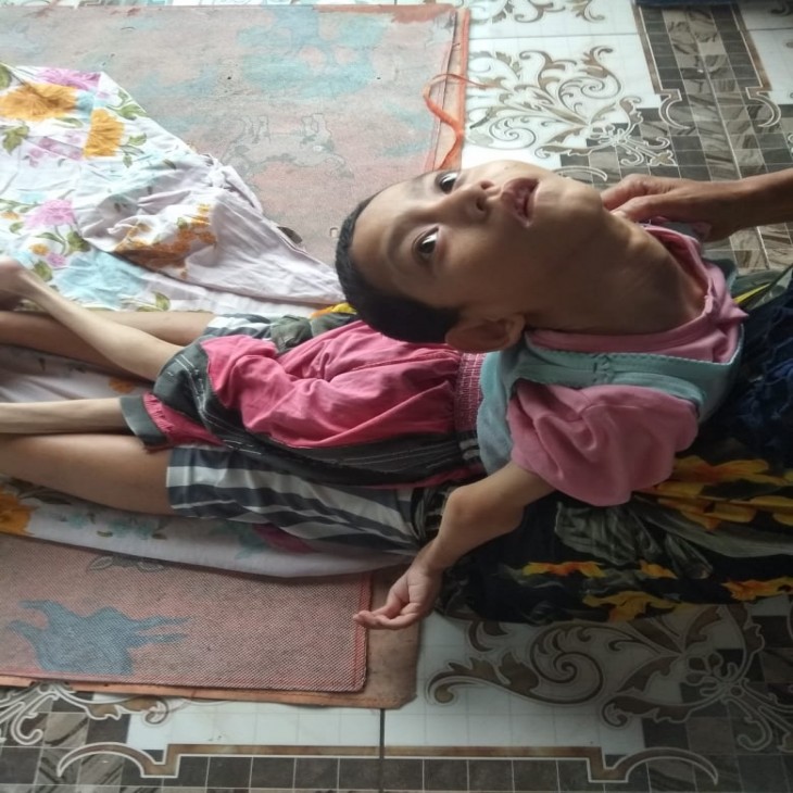 14 tahun Siva Berjuang lawan Penyakit Saraf Otak