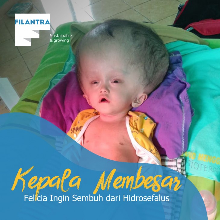 Kepala Felicia Kian Membesar Melebihi Ukuran Tubuh