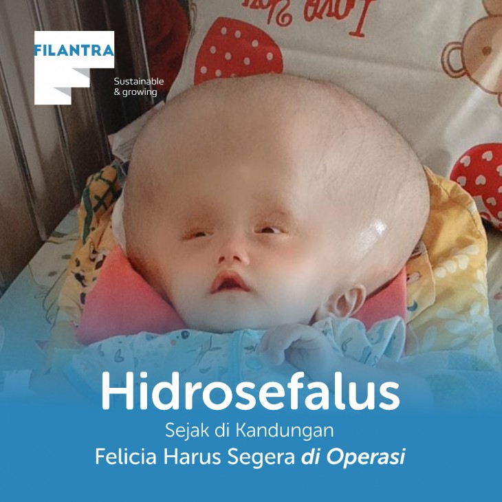 Kepala Felicia Kian Membesar Melebihi Ukuran Tubuh