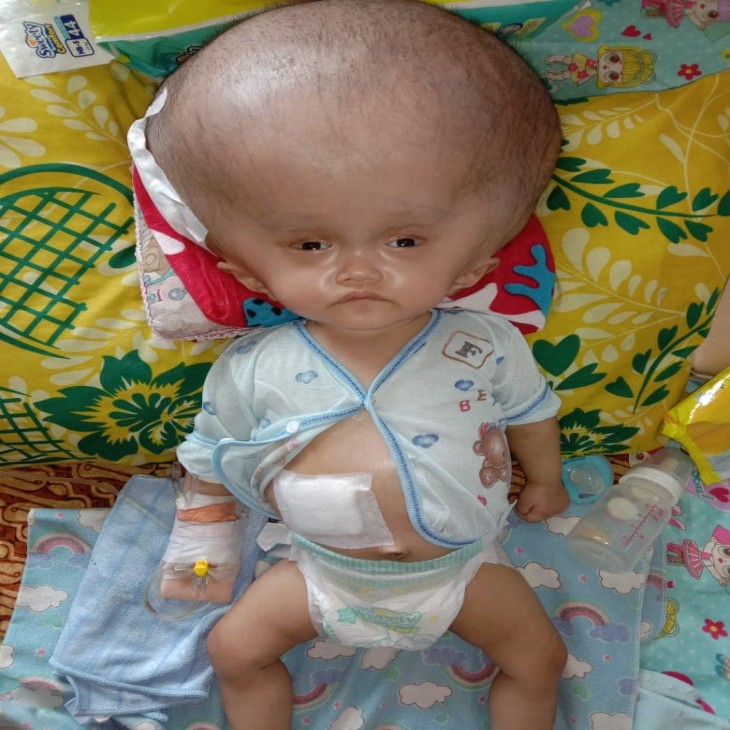 Kepala Felicia Kian Membesar Melebihi Ukuran Tubuh