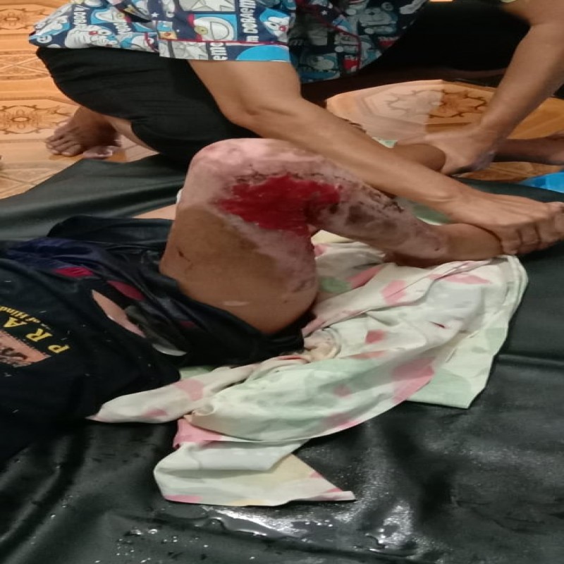 Badan Perih dan Panas Karena Luka Bakar Bantu Farel Sembuh