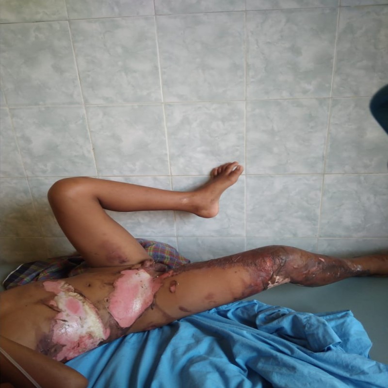 Badan Perih dan Panas Karena Luka Bakar Bantu Farel Sembuh