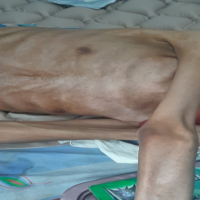 Badan Semakin Kurus, Dang Ridho Berjuang Lawan TBC Tulang & Diabetes