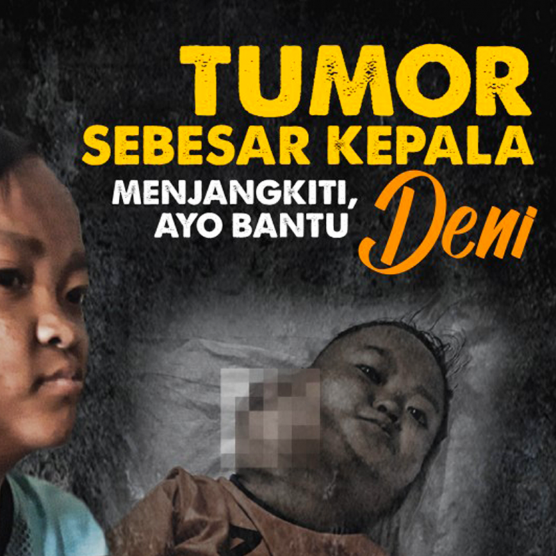 Tumor Sebesar Kepala Bersarang di Leher Deni, Ayo Bantu Ia Sembuh