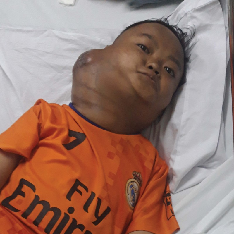 Tumor Sebesar Kepala Bersarang di Leher Deni, Ayo Bantu Ia Sembuh
