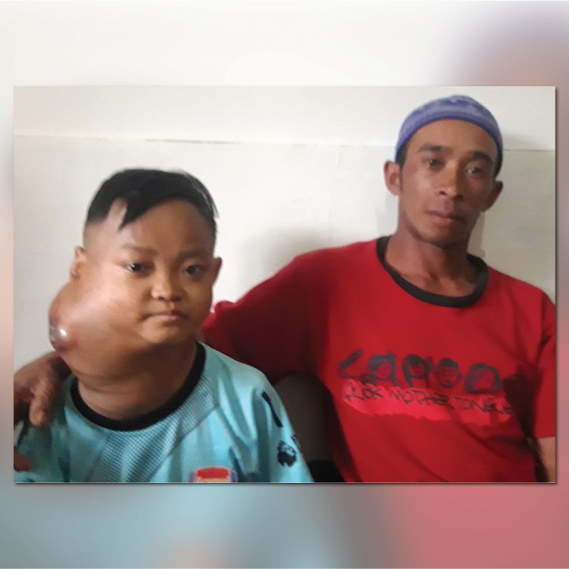 Tumor Sebesar Kepala Bersarang di Leher Deni, Ayo Bantu Ia Sembuh