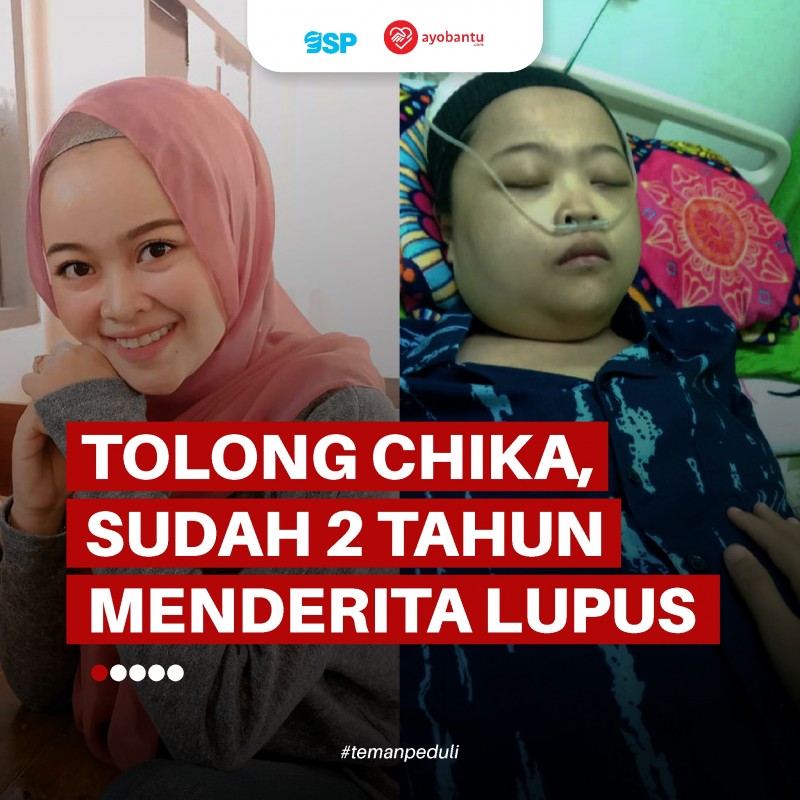 Chika, 2 Tahun Menderita Lupus dan Komplikasi di Tengah Keterbatasan Ekonomi