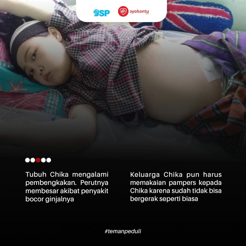 Chika, 2 Tahun Menderita Lupus dan Komplikasi di Tengah Keterbatasan Ekonomi