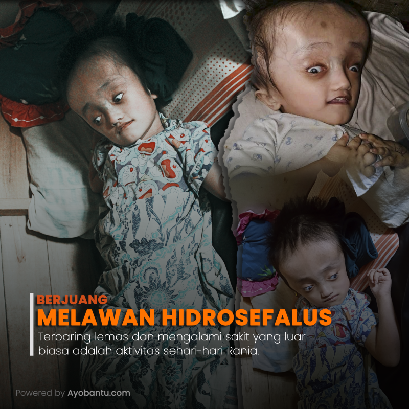 16 Tahun Mengidap Hydrosefalus, Rania Ingin Sembuh
