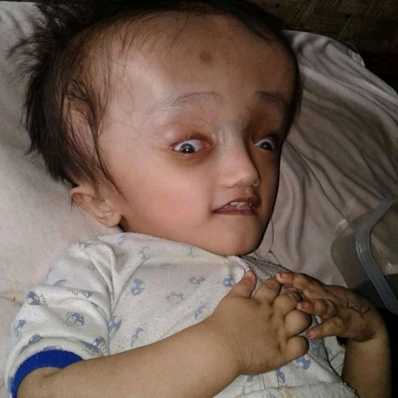 16 Tahun Mengidap Hydrosefalus, Rania Ingin Sembuh