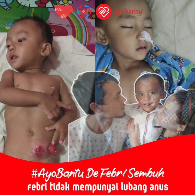 Hampir Menyerah ketika de Febri Mengalami Kembali Penyakit Baru ( Hipospadias ) Setelah Colostomy Sembuh.