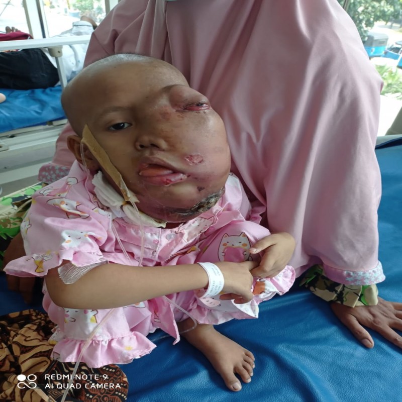 BANTU NUR ASYIFAH LAWAN TUMOR GANAS