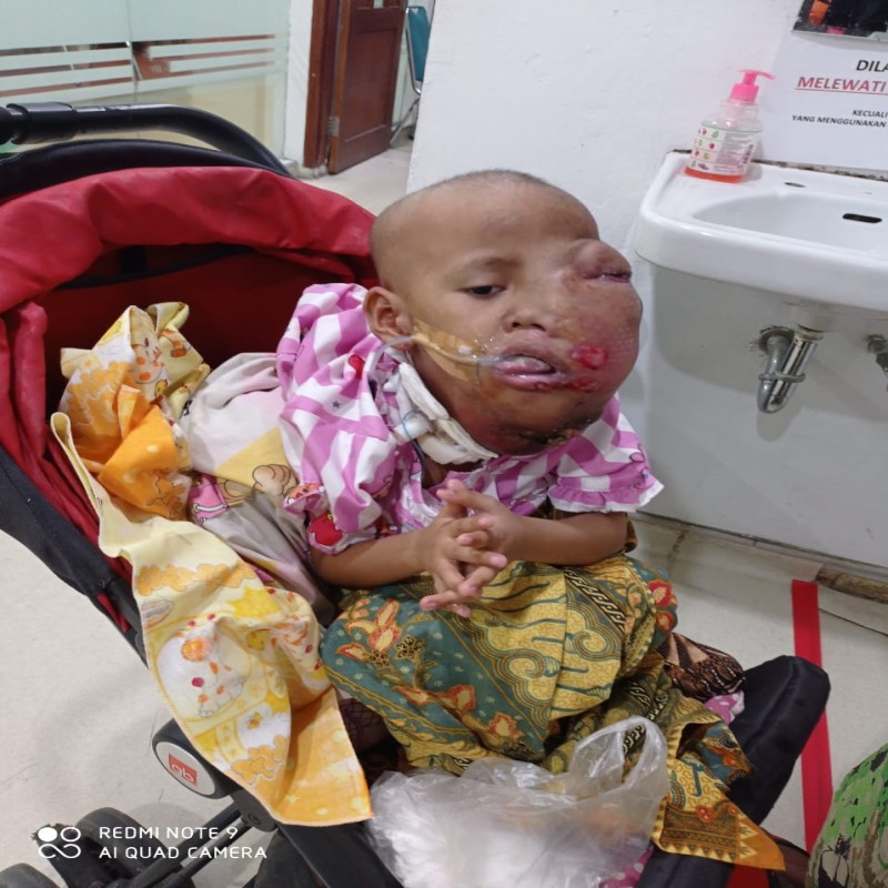 BANTU NUR ASYIFAH LAWAN TUMOR GANAS