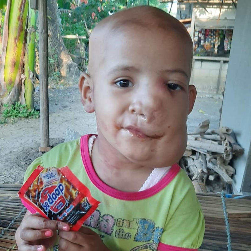 BANTU NUR ASYIFAH LAWAN TUMOR GANAS