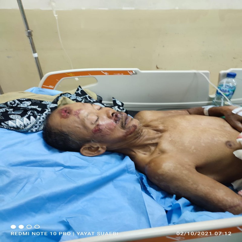 Ayo Bantu Pak Pee Sembuh, Penyandang Disabilitas yang Hidup Sebatang Kara