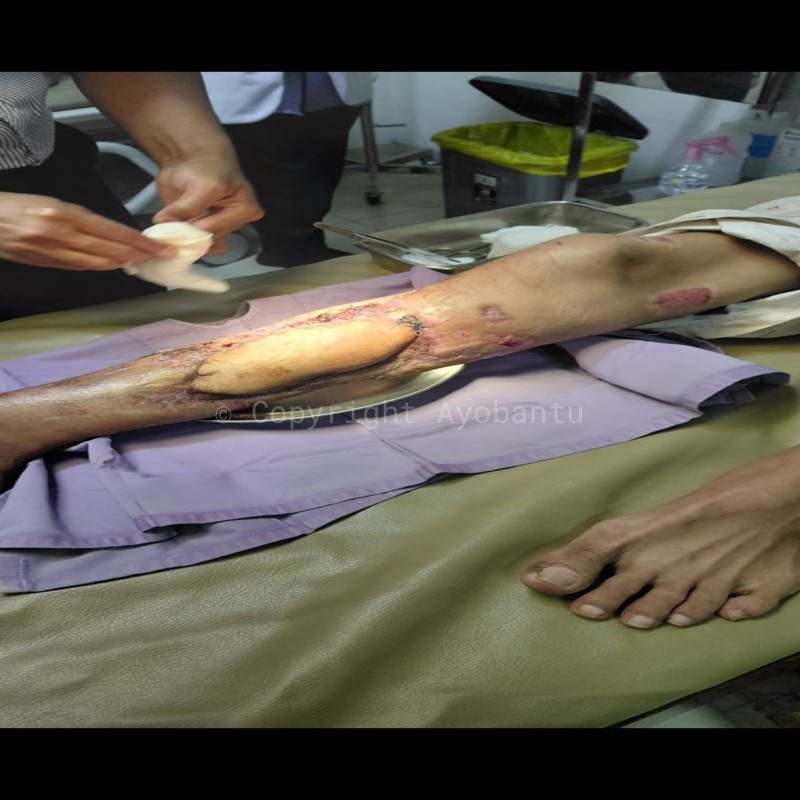 Menjadi korban tabrak lari Driver Gojek berjuang melawan PATAH KAKI kanan.