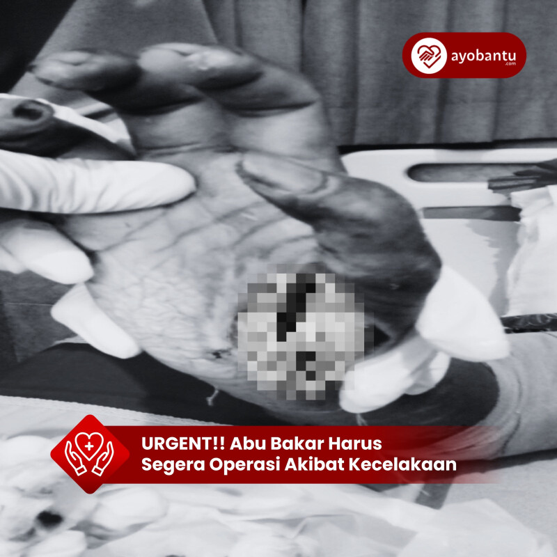 Bantu Abu Bakar Ash Shidiq Pulihkan Patah Tulang dan Luka luka