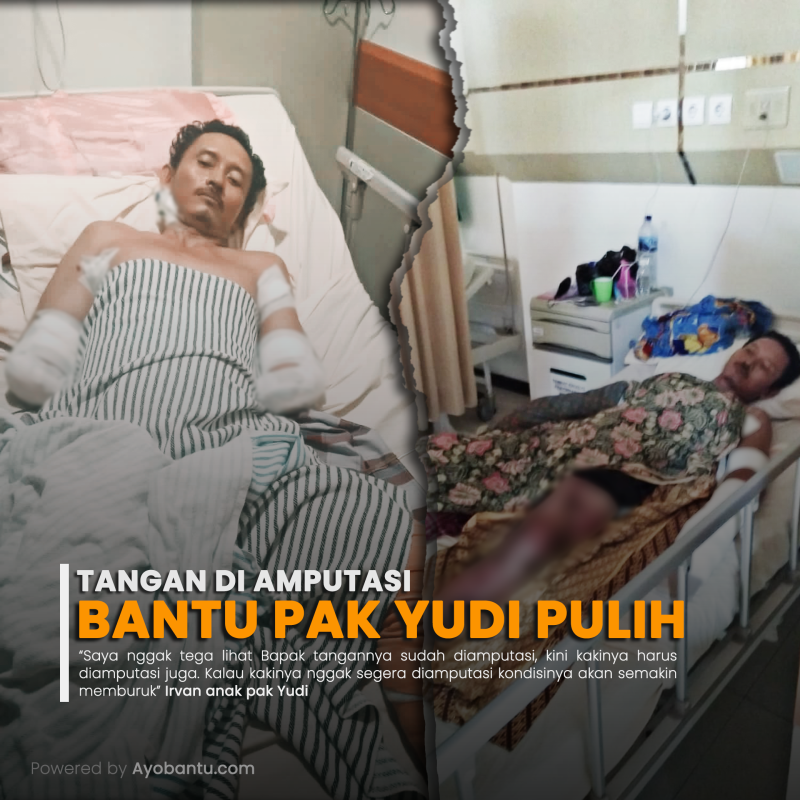 Tersengat Listrik, Tangan Pak Yudi Diamputasi, Mari Kita Bantu Untuk Pulih !!