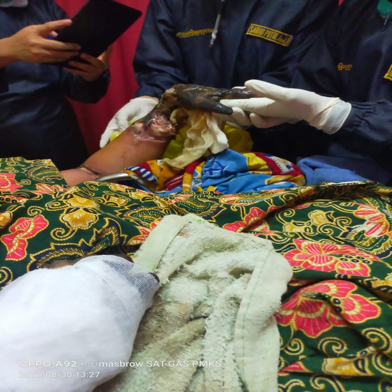 Tersengat Listrik, Tangan Pak Yudi Diamputasi, Mari Kita Bantu Untuk Pulih !!