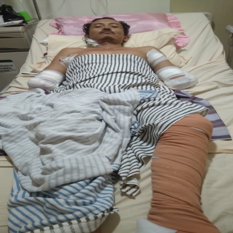 Tersengat Listrik, Tangan Pak Yudi Diamputasi, Mari Kita Bantu Untuk Pulih !!
