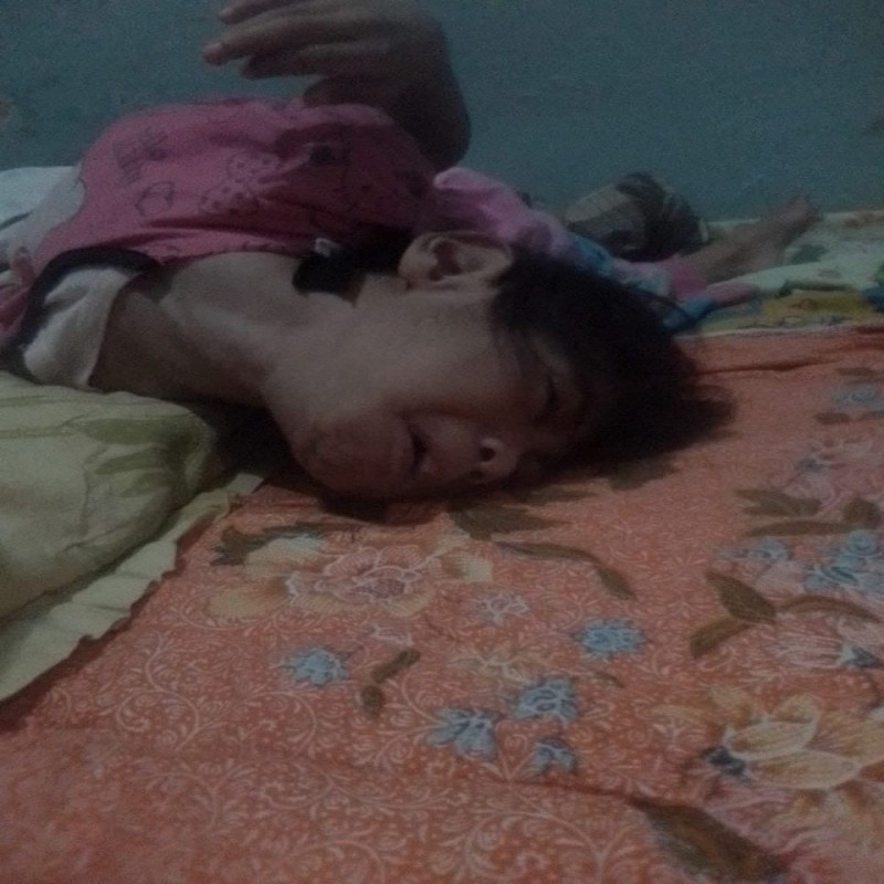 Sejak Lahir Nur Menderita Kelainan Punggung