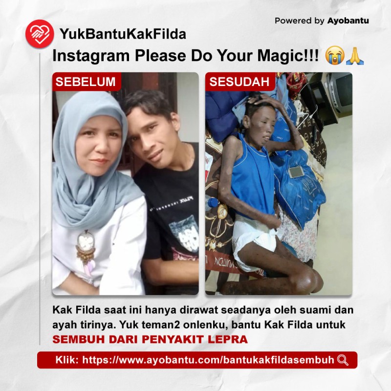 #BantuFildasari Sembuh dari Lepra