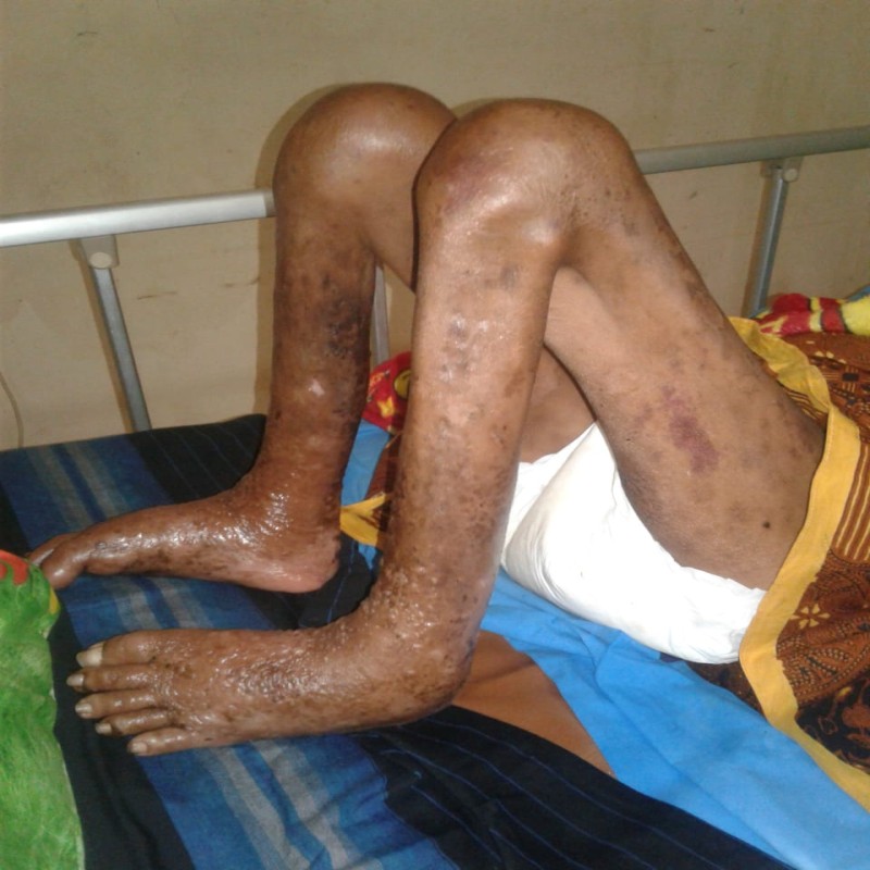 #BantuFildasari Sembuh dari Lepra