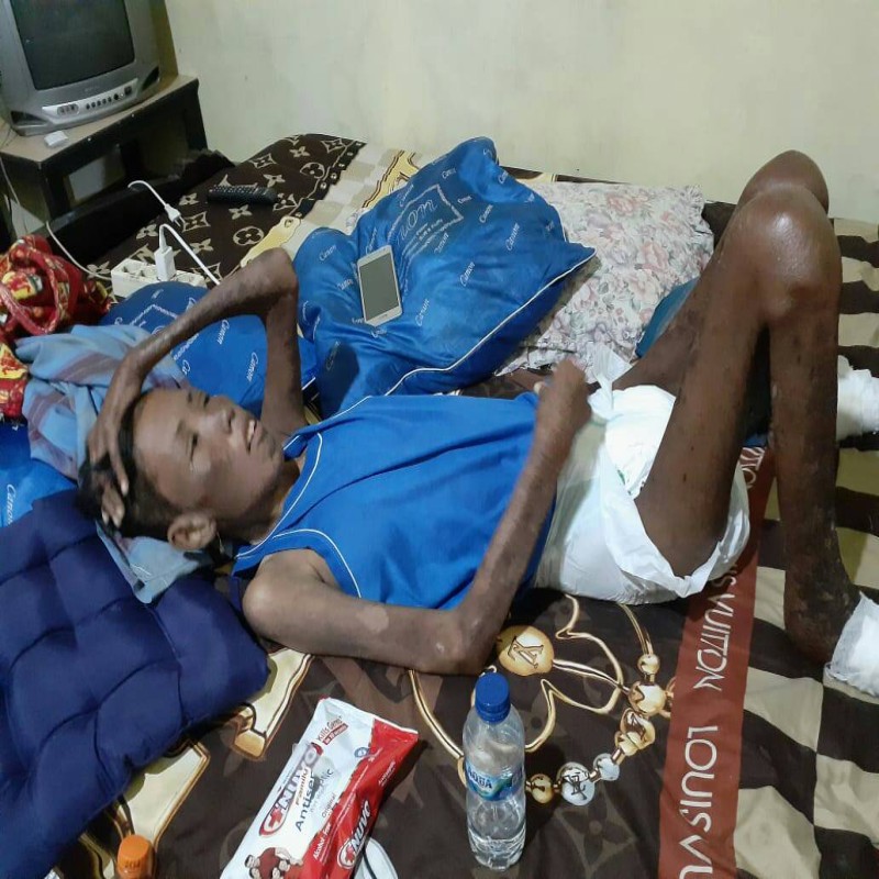 #BantuFildasari Sembuh dari Lepra