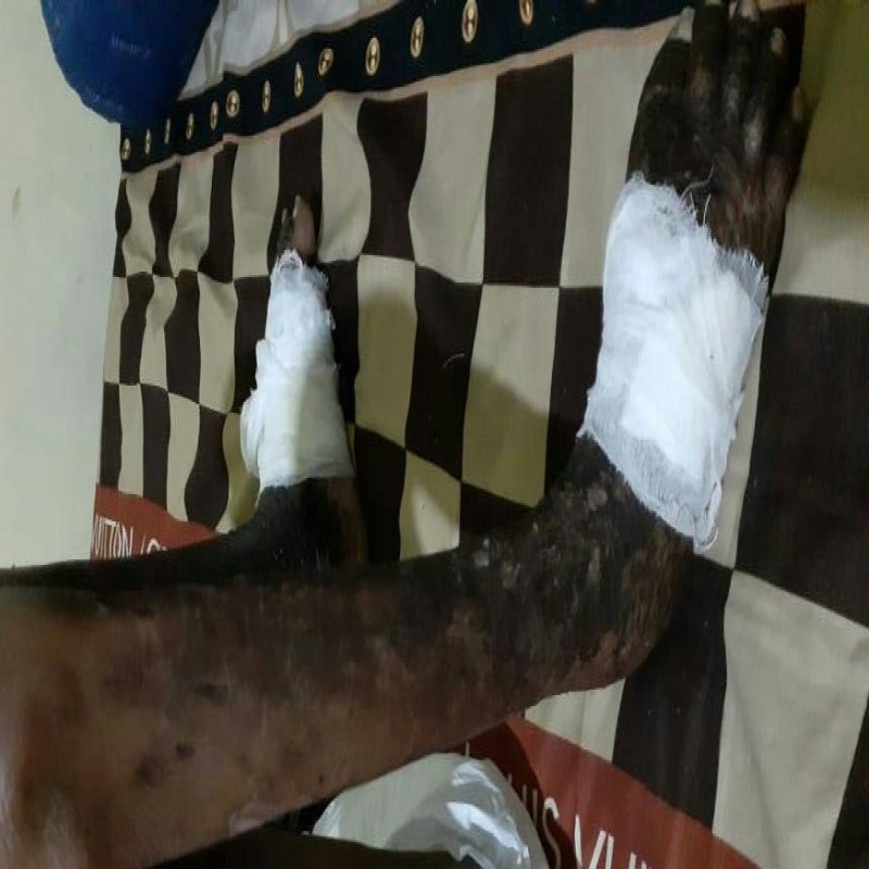 #BantuFildasari Sembuh dari Lepra