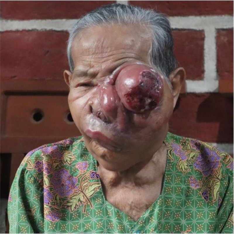 Sembuhkan Mbah Samirah dari Tumor Ganas