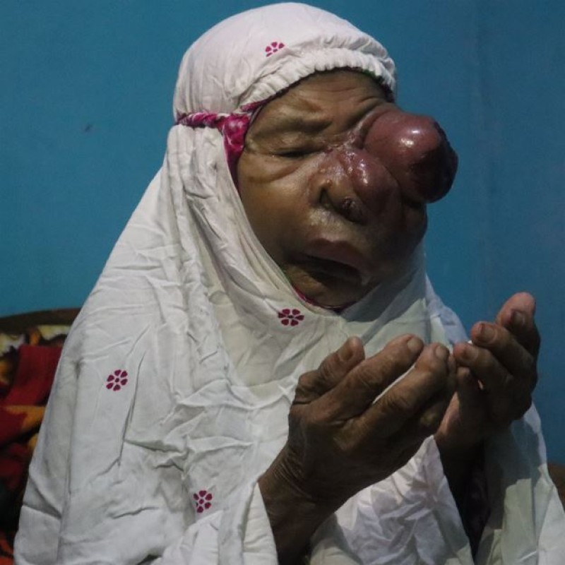 Sembuhkan Mbah Samirah dari Tumor Ganas