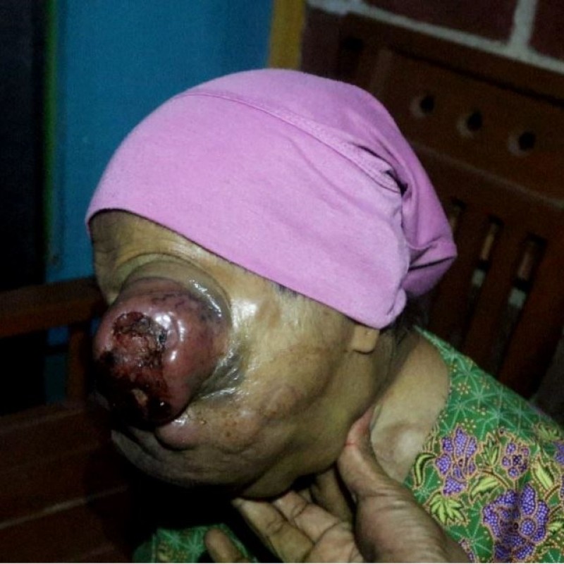 Sembuhkan Mbah Samirah dari Tumor Ganas