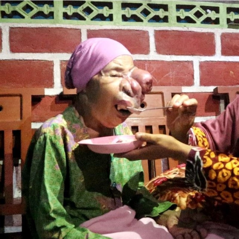 Sembuhkan Mbah Samirah dari Tumor Ganas