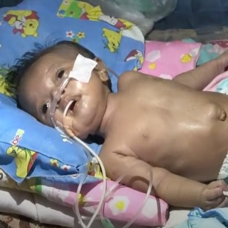 Bantu Fadila Sembuh dari Peradangan Paru-Paru