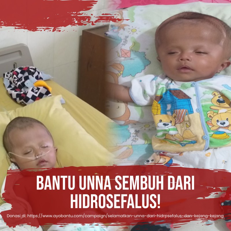 Selamatkan unna dari hidrpsefalus dan kejang kejang