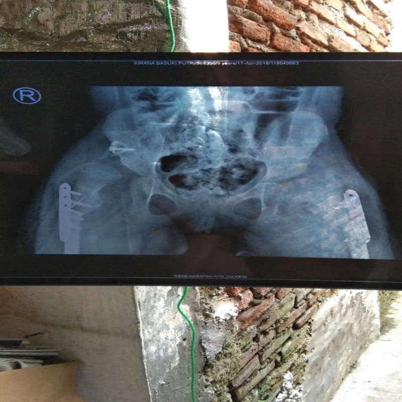 Bantu Kirana untuk sembuh dari lumpuh otak