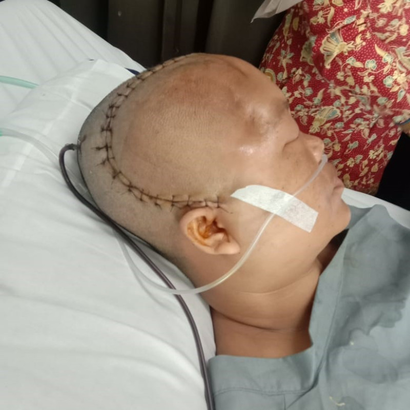 ISTRI KULI BANGUNAN HARUS JALANI BERKALI-KALI OPERASI BENJOLAN DI KEPALA