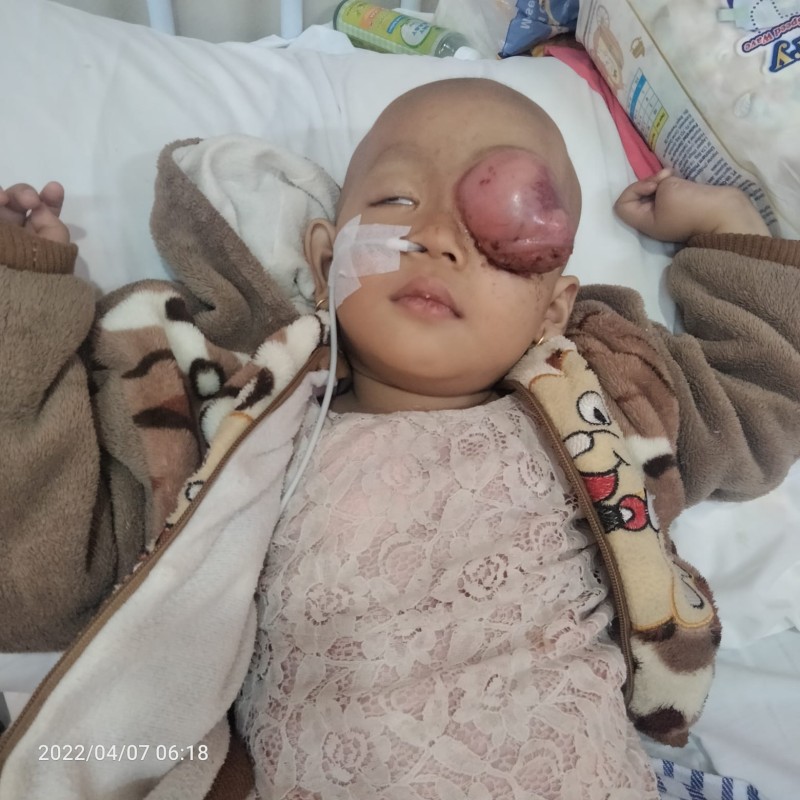 Mata Balqis Terus Membengkak Karena Ganasnya Kanker Rhabdomyosarcoma