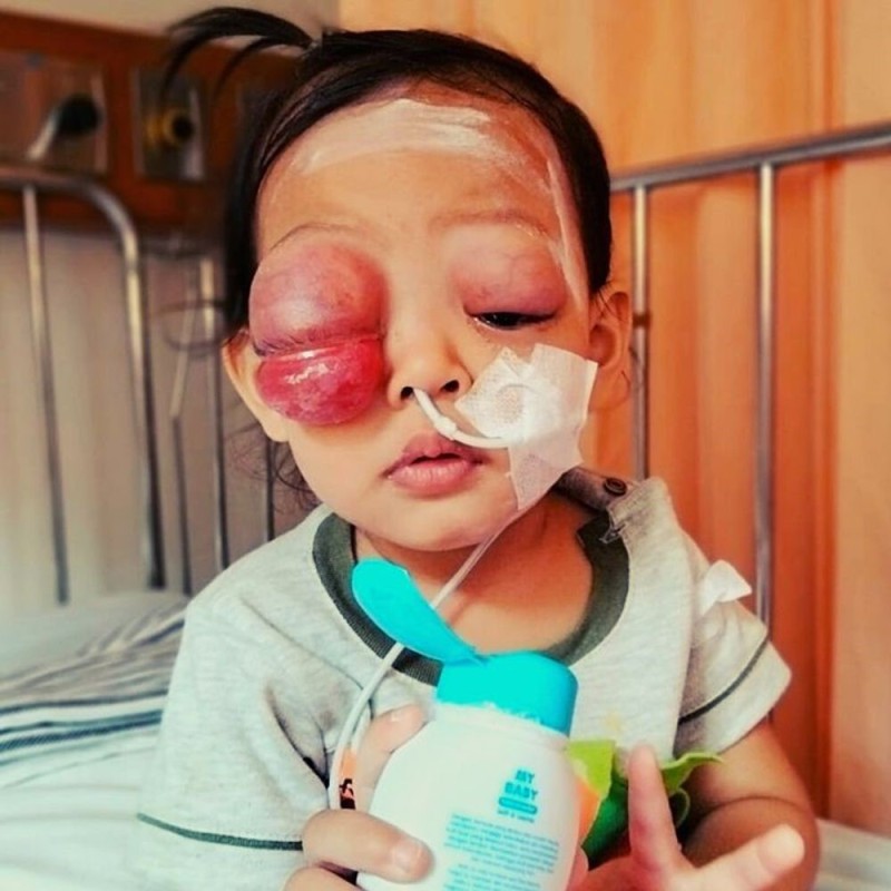 Mata Balqis Terus Membengkak Karena Ganasnya Kanker Rhabdomyosarcoma