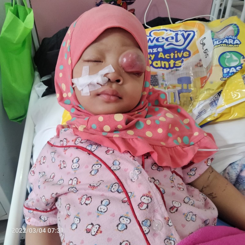 Mata Balqis Terus Membengkak Karena Ganasnya Kanker Rhabdomyosarcoma