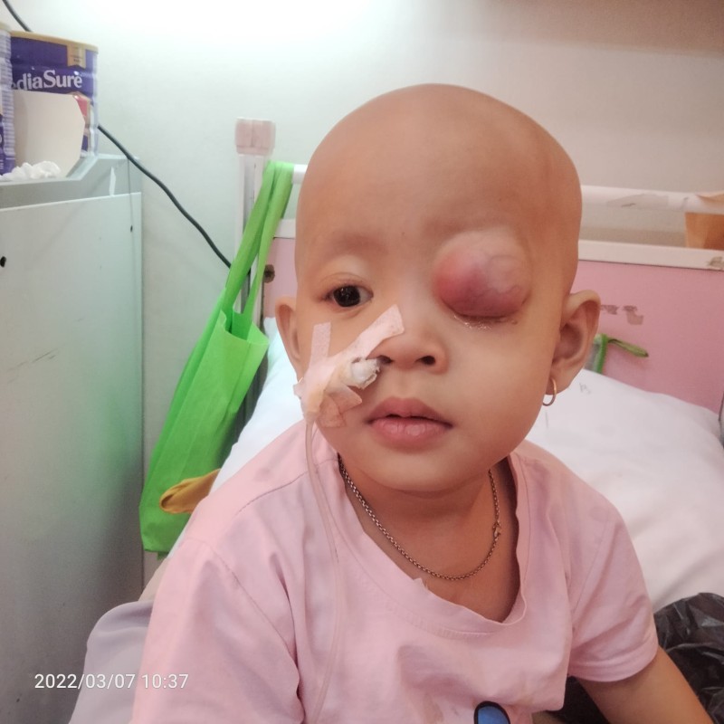 Mata Balqis Terus Membengkak Karena Ganasnya Kanker Rhabdomyosarcoma