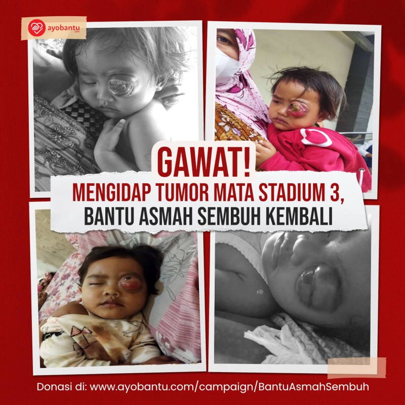 Mengidap Tumor Mata Stadium 3, Bantu Asmah Sembuh Kembali