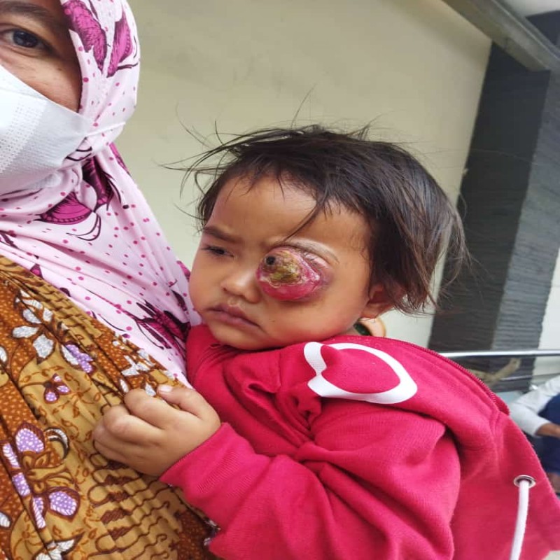 Mengidap Tumor Mata Stadium 3, Bantu Asmah Sembuh Kembali