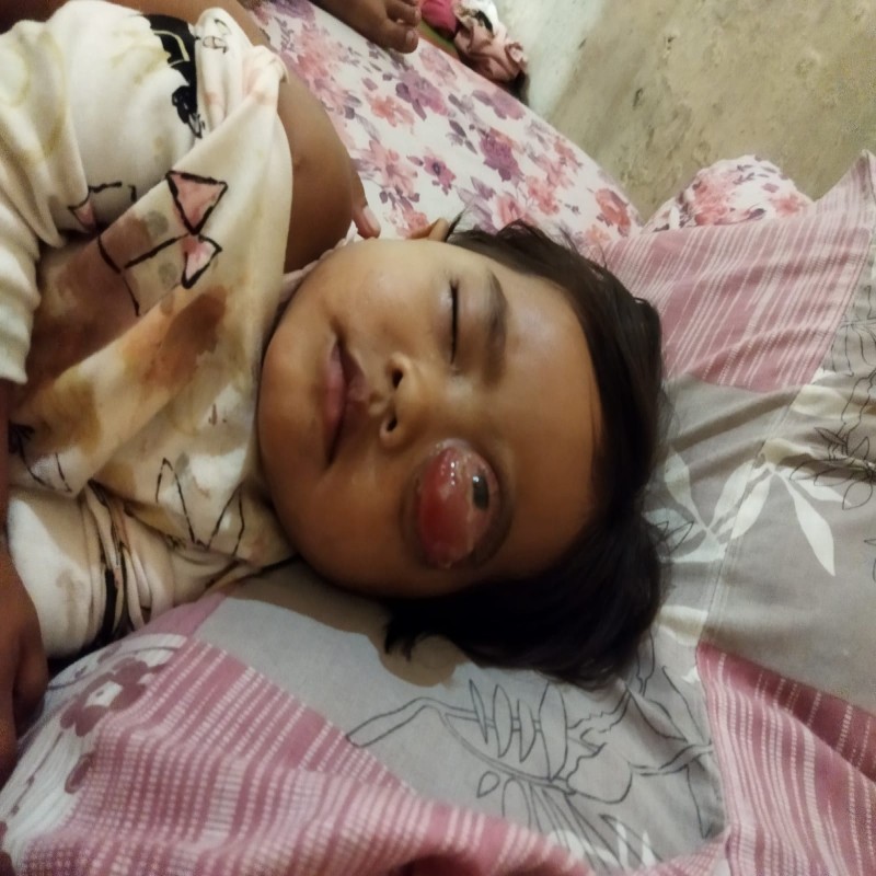 Mengidap Tumor Mata Stadium 3, Bantu Asmah Sembuh Kembali